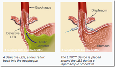 Implanted Medical Device for GERD (Gastroesophageal Reflux Disease) in ...
